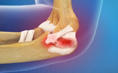 Best Elbow Brace for Tendonitis: Types, Benefits, and Expert Buying Guide