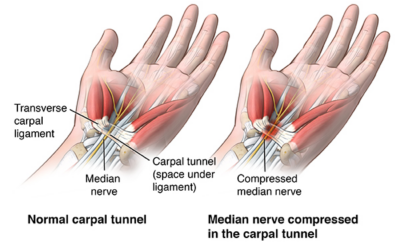 Does a Wrist Support for Carpal Tunnel Help?