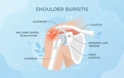 Does Wearing A Bursitis Shoulder Support Help?